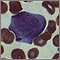 Mononucleosis, photomicrograph of cells