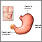 Gastrectomy  - series