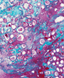 Thyroid gland adenoma - Copyright: Science Photo Library