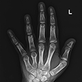 Image of bilateral x-ray films showing shortened fourth and fifth metacarpals