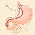 Image of bariatric surgery