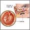 Middle ear infection