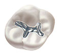 Picture of a dental amagam embedded in a tooth