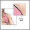 Chest tube insertion - series