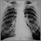 Coal worker's lungs - chest X-ray