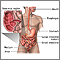Crohn's disease - affected areas