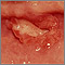 Canker sore (aphthous ulcer)