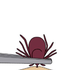 tweezers grasping a tick close to the skin's surface