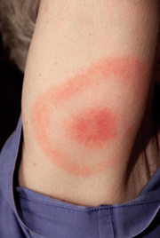 Lesion with bulls-eye target shape on the back of a patient