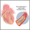 Coronary artery stent