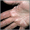 Hyperlinearity in atopic dermatitis, on the palm