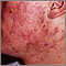 Acne, cystic on the face