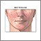 Adult facial acne