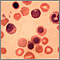 Erythroblastosis fetalis, photomicrograph