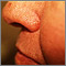 Basal cell carcinoma - nose