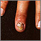 Nail infection, candidal