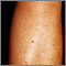 Folliculitis on the leg