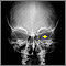Neurofibromatosis I, enlarged optic foramen