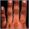 Acanthosis nigricans on the hand