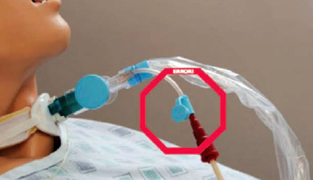 Enteral feeding tube erroneously connected to ventilator in-line suction catheter on mannequin