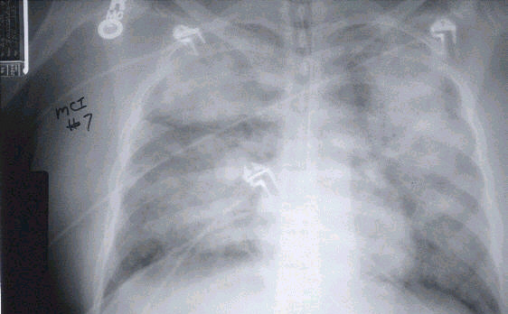 x-ray view of lungs of a patient with severe HPS