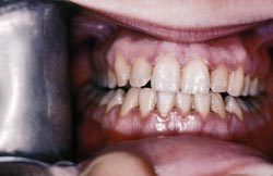 A photo of teeth with Gingivitis