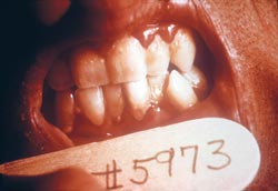 A photo of teeth with periodontitis