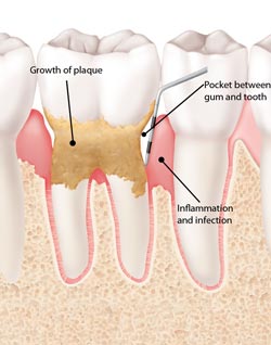 Illustration of a tooth with groth of plaque, a pocket between gum and tooth and inflammation and infection