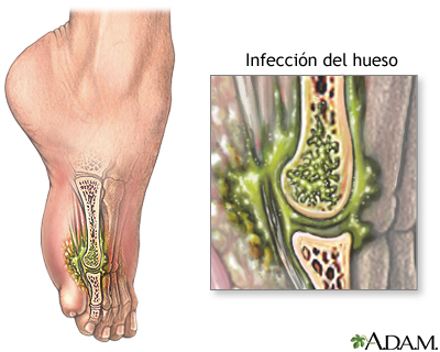 Osteomielitis