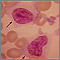 Mononucleosis, microfotografía de la célula