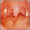 Mononucleosis: vista de la garganta