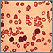 Leucemia linfocítica crónica; vista microscópica