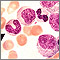 Vista microscópica: leucemia mielocítica crónica