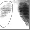 Ruptura aórtica, radiografía de tórax