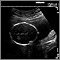 Ultrasonido de un feto normal; medidas de la cabeza
