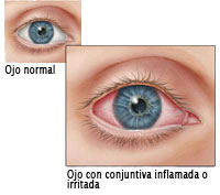 ilustracin de ojo normal y ojo irritado