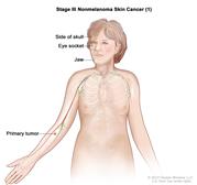 Stage III nonmelanoma skin cancer (1); drawing shows a primary tumor in one arm and parts of the body where it may spread, including the bones of the jaw, eye socket, or side of the skull.