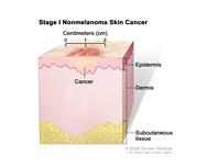 Stage I nonmelanoma skin cancer; drawing shows a tumor in the epidermis (outer layer of the skin) that is no more than 2 centimeters wide. Also shown are the dermis (inner layer of the skin) and the subcutaneous tissue below the dermis.