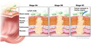 Stage II colorectal cancer; shows a cross-section of the colon/rectum and a three-panel inset. Each panel shows the layers of the colon/rectum wall: mucosa, submucosa, muscle layers, and serosa. Also shown are a blood vessel and lymph nodes. First panel shows stage IIA with cancer in the mucosa, submucosa, muscle layers, and serosa. Second panel shows stage IIB with cancer in all layers and spreading through the serosa. Third panel shows stage IIC with cancer spreading to nearby organs.