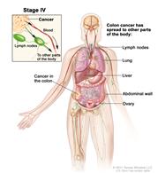 Stage IV colon cancer; shows other parts of the body where colon cancer may spread, including lymph nodes, lung, liver, abdominal wall, and ovary. Inset shows cancer spreading through the blood and lymph nodes to other parts of the body.