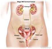 Stage IIIB cervical cancer; drawing shows cancer in the cervix, the vagina, and  the pelvic wall, blocking the ureter on the right. The uterus and kidneys are also shown.