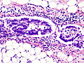 Serous adenocarcinoma ovarian cancer subtype
