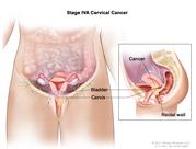 Stage IVA cervical cancer; drawing and inset show that cancer has spread from the cervix to the bladder and rectal wall.