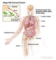 Stage IVB cervical cancer; drawing shows the places in the body where stage IV cervical cancer may spread, including the lymph nodes, lung, liver, intestinal tract, cervix, abdominal wall, and bone. Also shown is an inset of cancer that has spread to a lymph node and through the blood to other parts of the body.