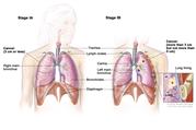 Two-panel drawing of stage I non-small cell lung cancer. First panel shows stage IA with cancer (3 cm or less) in the right lung; also shown are the right main bronchus, trachea, lymph nodes, bronchioles, and diaphragm. Second panel shows stage IB with cancer (more than 3 cm but not more than 5 cm) in the left lung and in the left main bronchus; the carina is also shown. Inset shows cancer that has spread from the lung into the innermost layer of the lung lining; a rib is also shown.