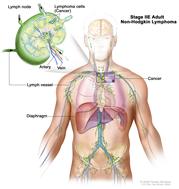 Stage IIE adult non-Hodgkin lymphoma; drawing shows cancer in one lymph node group above the diaphragm and in the left lung. An inset shows a lymph node with a lymph vessel, an artery, and a vein. Lymphoma cells containing cancer are shown in the lymph node.