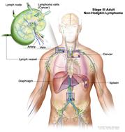 Stage III adult non-Hodgkin lymphoma; drawing shows cancer in lymph node groups above and below the diaphragm, in the left lung, and in the spleen. An inset shows a lymph node with a lymph vessel, an artery, and a vein. Lymphoma cells containing cancer are shown in the lymph node.
