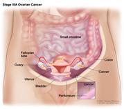 Stage IIIA ovarian cancer; drawing shows tumors inside both ovaries that have spread to the uterus, colon, and the surface of the peritoneum. Also shown are the fallopian tubes, small intestine, and bladder.