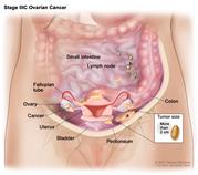 Stage IIIC ovarian cancer; drawing shows tumors inside both ovaries that have spread to the uterus, colon, small intestine, lymph nodes in the abdomen, and the surface of the peritoneum, where they are larger than 2 centimeters in diameter. An inset shows 2 centimeters is about the size of a peanut. Also shown are the fallopian tubes and bladder.