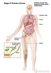 Stage IV ovarian cancer; drawing shows parts of the body where ovarian cancer may spread, including the liver, lung, lymph nodes, and bone. An inset shows a close-up of cancer spreading through the blood and lymph to other parts of the body.